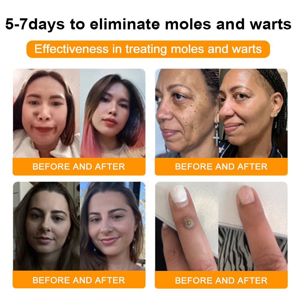 SkinRevive Bee Venom | Moedervlek- en Wratbehandelingcrème