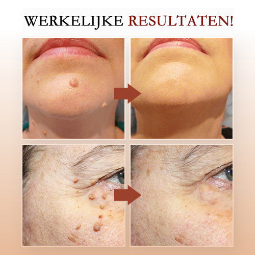 WipeOff Clean™ | Moedervlek en Wratten verwijderaar | 1 + 1 GRATIS