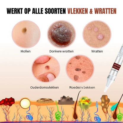 WipeOff Clean™ | Moedervlek en Wratten verwijderaar | 1 + 1 GRATIS
